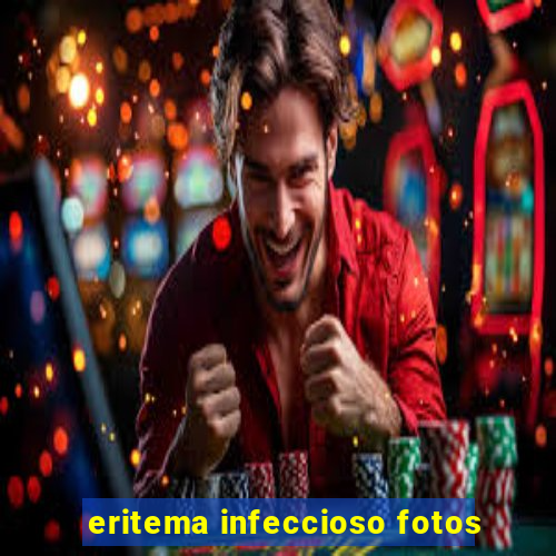 eritema infeccioso fotos