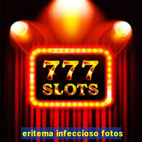 eritema infeccioso fotos